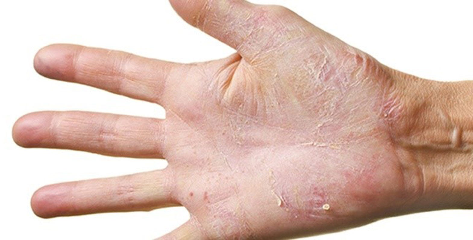 Skin reactions - is it really from the gloves?